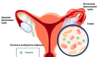 Сальпингит: симптомы и методы лечения